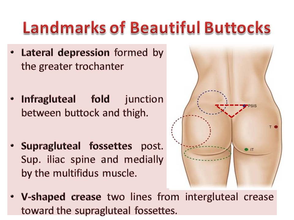 A Review of Recent Advances in Aesthetic Gluteoplasty and Buttock Contouring